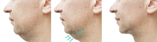 Male Double Chin Treatment — Stock Photo, Image