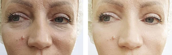 Woman Wrinkles Face Treatments — Stock Photo, Image