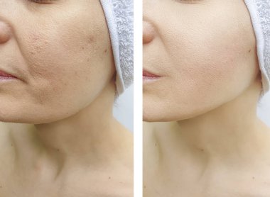 kadın yüz kırışıklıklar önce ve sonra düzeltme