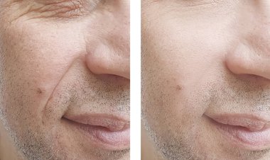 adam güzellik düzeltme öncesi ve sonrası kırışıklıkları yüz