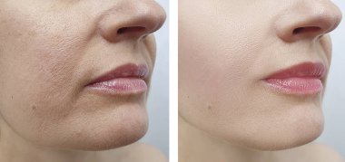 Kadın tedaviden önce ve sonra kırışıklıklarla karşılaşır