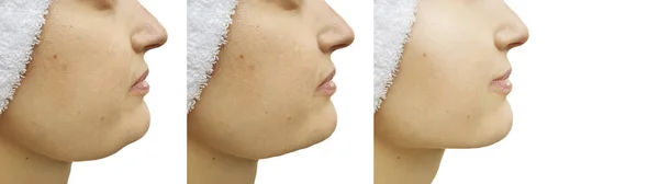 Woman Double Chin Correction — 스톡 사진