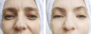 kadın yüz kırışıklıklar önce ve sonra düzeltme