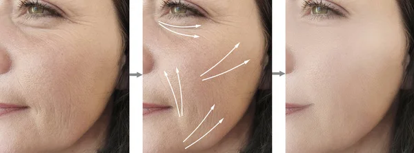 woman face wrinkles before and after correction