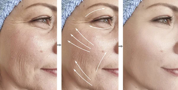 Woman Face Wrinkles Correction — Stock Photo, Image