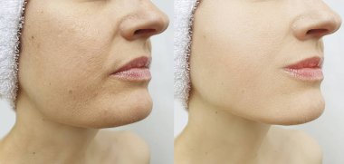 kadın yüz kırışıklıklar önce ve sonra düzeltme