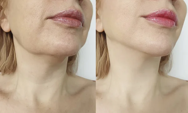 Female Double Chin Correction — Stock Photo, Image