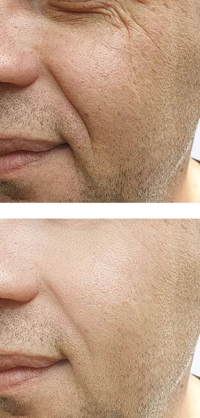 Mann Gesicht Falten Vor Und Nach Behandlungen — Stockfoto