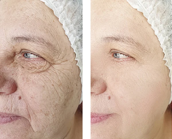 Face Wrinkles Elderly Woman Treatment — Stock Photo, Image