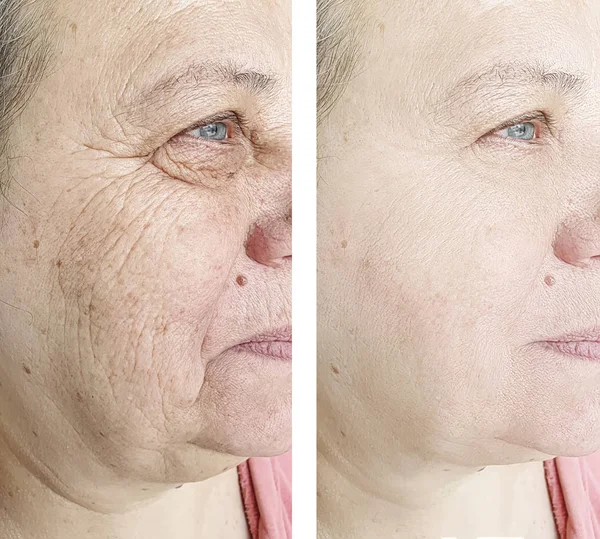 Face Wrinkles Elderly Woman Treatment — Stock Photo, Image