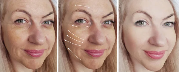 Kvinna Rynkor Ansikte Före Och Efter Behandling Collage — Stockfoto