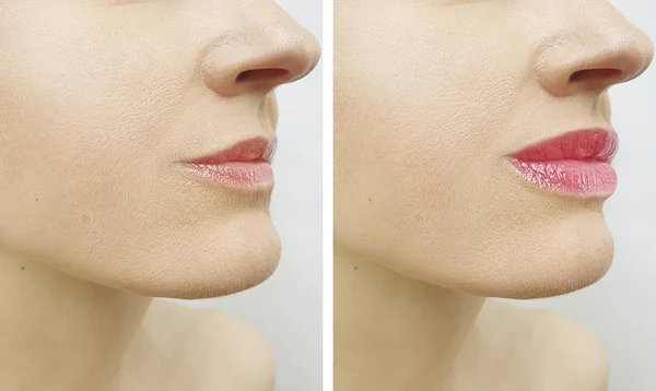 woman lips before and after augmentation