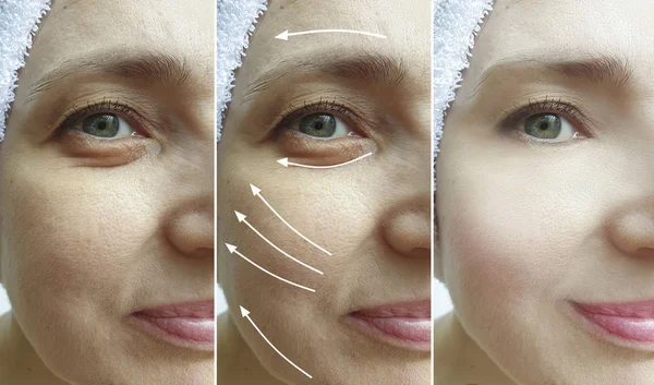 Woman Wrinkles Face Correction Collage — Stock Photo, Image