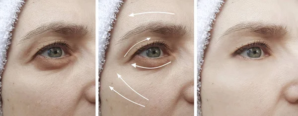 Wanita Keriput Wajah Sebelum Dan Setelah Koreksi Kolase — Stok Foto