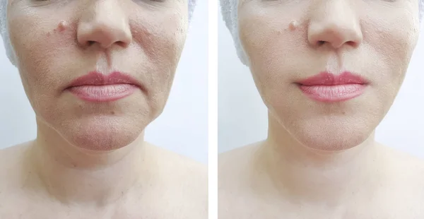 Arrugas Cara Mujer Antes Después Corrección —  Fotos de Stock