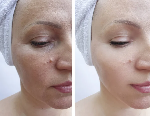 Arrugas Cara Mujer Antes Después Corrección —  Fotos de Stock