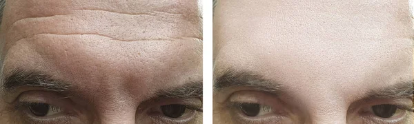 male forehead wrinkles before and after treatment