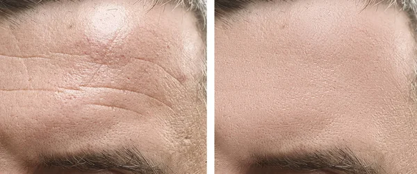 male forehead wrinkles before and after treatment