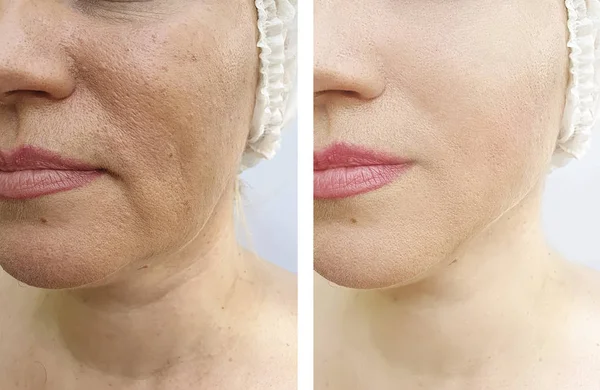 Rugas Cara Mulher Antes Depois Correção — Fotografia de Stock