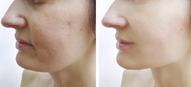 Kadın tedaviden önce ve sonra kırışıklıklarla karşılaşır