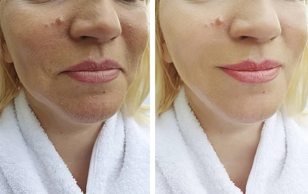 woman face wrinkles before and after correction