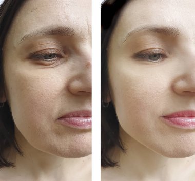 Kadın tedaviden önce ve sonra kırışıklıklarla karşılaşır