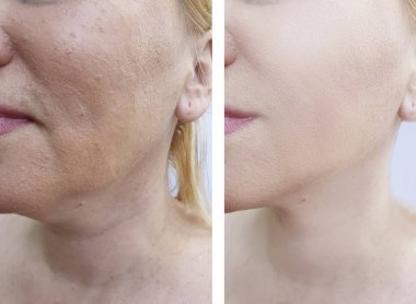 Kadın tedaviden önce ve sonra kırışıklıklarla karşılaşır