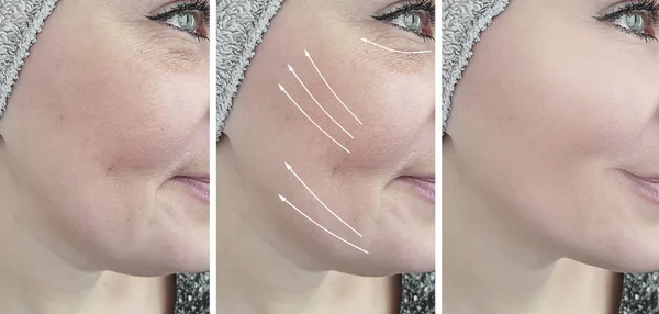 woman face wrinkles before and after treatment