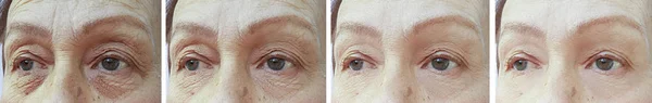 old woman wrinkles before and after correction