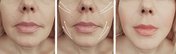 Woman Wrinkles Face Correction Arrow Collage — Stock Photo, Image