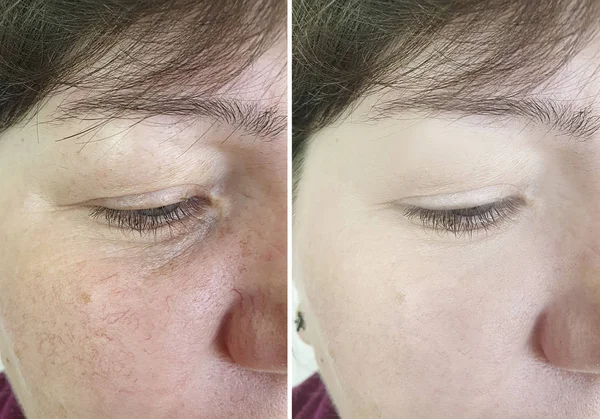 woman face wrinkles before and after treatment