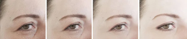 Augenfältchen Vor Und Nach Der Behandlung — Stockfoto