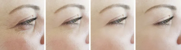 Ojos Mujer Arrugas Antes Después Del Tratamiento —  Fotos de Stock