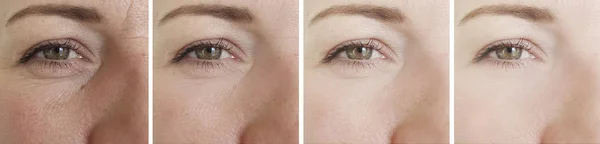 woman eyes wrinkles before and after treatment