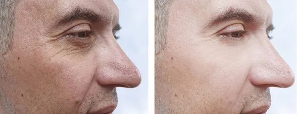 治療前と治療後の男性の顔のしわ — ストック写真