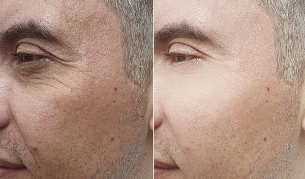 Arrugas Cara Del Hombre Antes Después Del Tratamiento — Foto de Stock