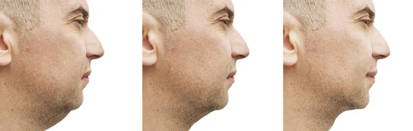 Männliches Doppelkinn Vor Und Nach Der Behandlung — Stockfoto