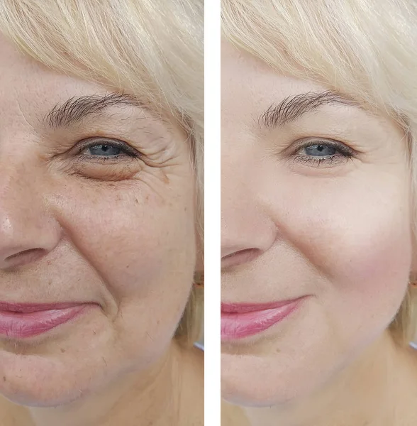 Elderly Women Face Wrinkles Treatment — Stock Photo, Image