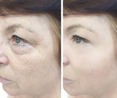 face of an elderly woman before and after treatment clipart