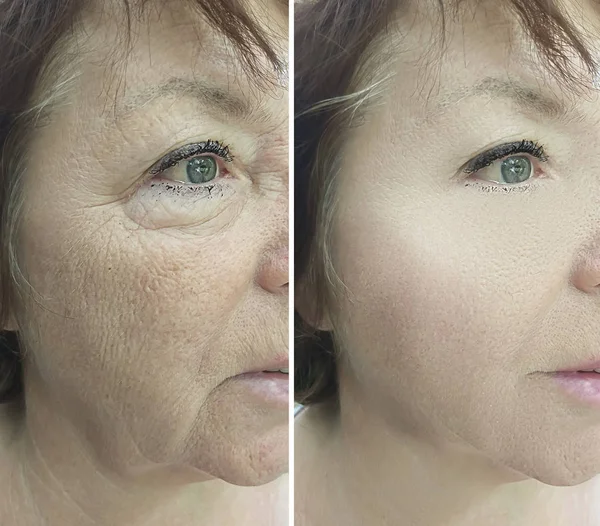 治療前後の高齢女性の顔 — ストック写真