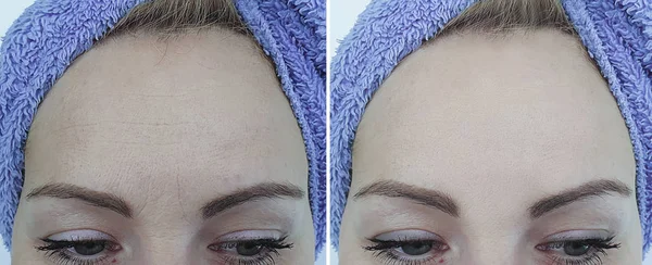 治疗前后女性额头皱纹 — 图库照片