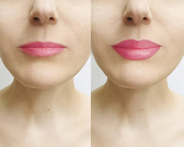 Wanita Bibir Sebelum Dan Sesudah Pembesaran — Stok Foto