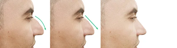 Joroba Nasal Masculina Antes Después Del Tratamiento — Foto de Stock