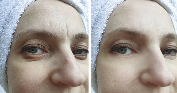 kadın yüz kırışıklıklar önce ve sonra düzeltme