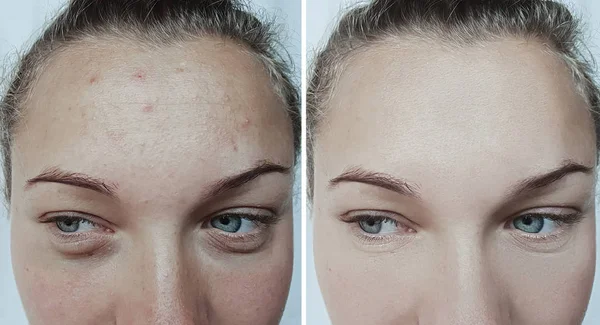 Wanita Wajah Keriput Sebelum Dan Setelah Pengobatan — Stok Foto