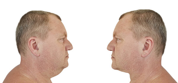 мужской двойной подбородок до и после лечения
