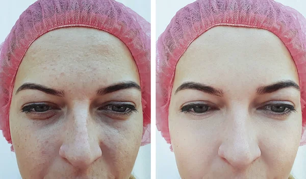 Rugas Dos Olhos Mulher Antes Após Tratamento — Fotografia de Stock