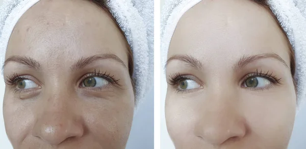 Cara Las Arrugas Mujer Antes Después Del Tratamiento Tensión Relleno — Foto de Stock