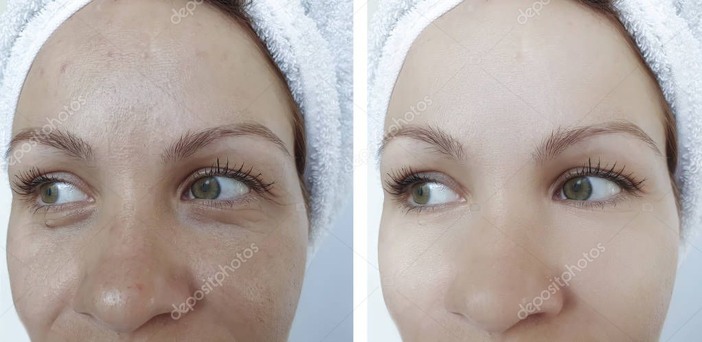 woman wrinkles face before and after treatment, tension, filler, bloating