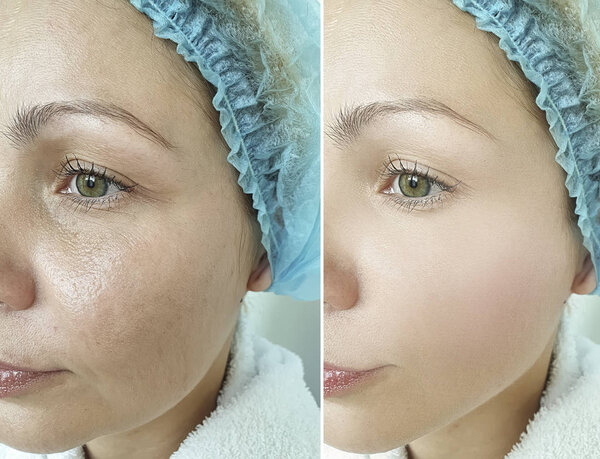 woman wrinkles face before and after treatments